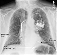 Image result for Cardiac Resynchronization Therapy