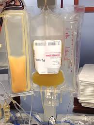 Image result for Platelet Transfusion