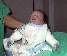 Hypoplastic Left Heart Syndrome Wikipedia