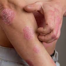 Image result for psoriasis