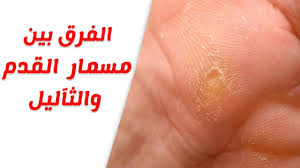 اعراض مسمار القدم وعلاجه والفرق بينه وبين ثآليل القدم Youtube