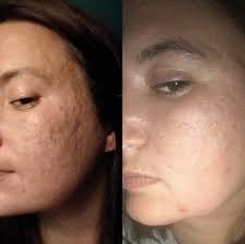 All of the sudden my entire left cheek and forehead is covered in what looks like an acne breakout. Stress Acne The Best Products To Help Ease The Breakouts