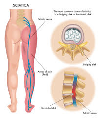 Gluteus maximus muscle pain and symptoms can be similar to, contribute to, and be affected by these medical diagnoses: Sciatica Pain Hip Pain Causes Symptoms Treatment