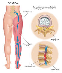 The most common symptom of sciatica is lower back pain that extends through the hip and buttock and down one leg. Sciatica Pain Hip Pain Causes Symptoms Treatment
