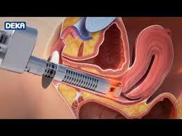 Monalisa Touch Perth Dr Anh Plastic Surgery Medispa