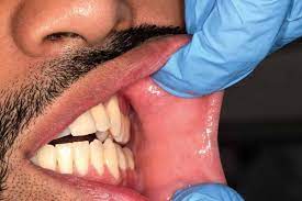 The surgeon looks at the soft palate, through the mouth and nose, using a special instrument. How Dentists Can Screen For Mouth Cancer Dentistry Co Uk
