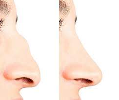 How Fillers Can Enhance Your Nose Without Surgery | Non Surgical Nose Job  in Delhi