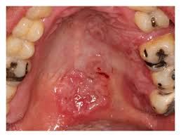Super angebote für syphilis cleartest hier im preisvergleich. Clinical Spectrum Of Oral Secondary Syphilis In Hiv Infected Patients