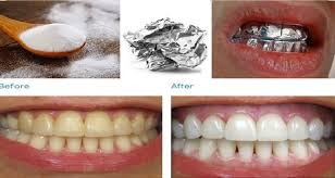 These are diy pens containing very little amounts of hydrogen peroxide. Diy Teeth Whitening Strips With Aluminum Foil Teeth Poster