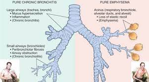 According to the centers for disease control and prevention (cdc). Chronic Bronchitis Vs Emphysema Nurse Pathophysiology Nursing Medical Surgical Nursing