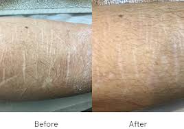 One of the main issues with removing vaginal ingrown hairs is the often awkward positioning required to see and reach the affected area. Acne Scar Removal Melbourne Acne Scar Treatment