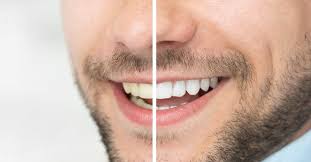 Image result for Tooth Discoloration
