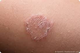 Ringworm Prevention Ringworm is a common skin infection that is caused by a fungus. ringworm prevention