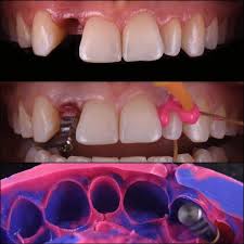 Impression Of Right Lateral Incisor With Customised Impression Coping Double Cord Was Placed On Left Lateral Incis Estetica Dental Ortodoncia Dental