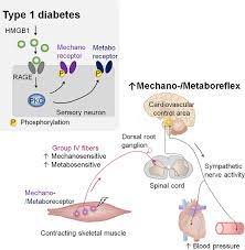 Skeletal Muscle Reflex Induced Sympathetic Dysregulation And Sensitization Of Muscle Afferents In Type 1 Diabetic Rats Hypertension