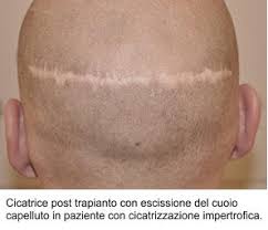 Non utilizzare la macchina per almeno un anno . Coprire La Cicatrice Post Trapianto Capelli Trapianto Capelli Hsd