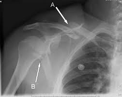 In addition to covering anteroposterior and lateral radiographs, dr. Plain Radiography Of The Upper Extremity In Adults Chapter 1 Clinical Emergency Radiology