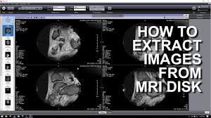 The application footprint is under 120 k and can be sent with the images. How To Extract Images From A Mri Dicom Disk Youtube