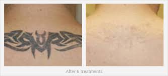 Yes, laser tattoo removal does hurt, but so does having a tattoo that you hate. Cost Of Tattoo Removal North Houston Laser Tattoo Removal