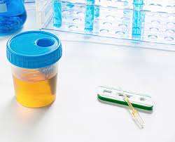 Importance Of Urine Culture Test In The Diagnosis Of Utis