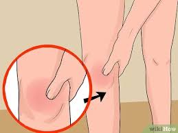 Sendi lutut bengkak( picture 1 ) adalah gejala umum yang timbul baik dari kelengkungan cedera memutar adalah penyebab utama kerusakan ligamen lutut dan sering menyebabkan lutut tidak stabil. 4 Cara Untuk Merawat Lutut Yang Bengkak Wikihow