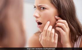 Your skin can get dry, especially in cold weather, which increases sebum production and can lead to forehead acne. Acne Prevention Tips Sudden Acne Breakout Causes And Tips For Prevention