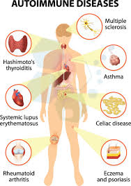 The symptoms, types, causes, and who is at risk for developing this chronic autoimmune disease. Modified Stem Cell Treatment For Lupus Sle