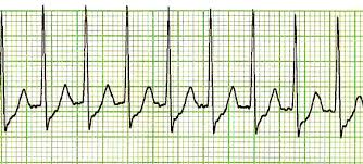 Il risultato è che la gittata cardiaca cessa completamente. Tachicardia Sopraventricolare Wikipedia