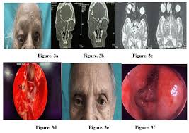 Journal of Clinical Otorhinolaryngology AUCTORES
