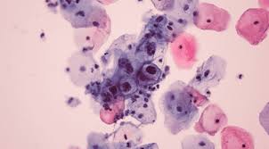 Image result for human papillomavirus symptoms