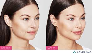 Clinical study shows high level of patient satisfaction with Restylane  Kysse