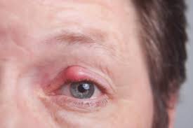 Fremdkorpergefuhl Im Auge Ursachen Behandlung Hilfe Medlexi De