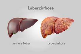 Leberzirrhose Naturlich Entgegenwirken