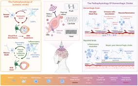 Image result for Stroke Pathophysiology