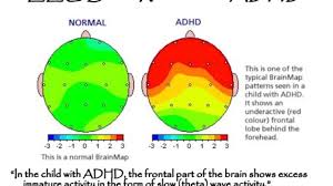 Adhd is the most commonly diagnosed mental disorder in children. Differences In Brain Structure For Children With Adhd Adhd Specialists