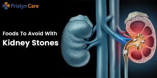 Foods To Avoid With Kidney Stones Pristyn Care