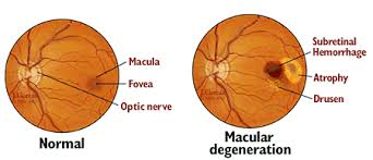 Macular Degeneration Eye Diagram Catalogue Of Schemas