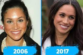 Фото меган маркл до и после пластики, уверенность и предположения. Chtoby Privlech Princa Garri Megan Markl Sdelala Rinoplastiku