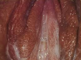 Image result for Friable Cervix