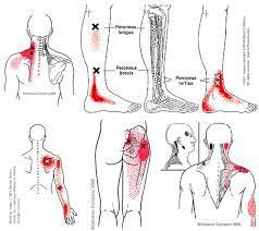 Pin On Mf Trigger Points