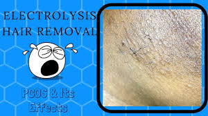 30 minutes electrolysis hair removal. Electrolysis Hair Removal Pcos Facial Hair Trinidad Youtuber Youtube