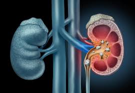 If your kidney stones give you pain, it will likely feel sharp and be localized to the area described above. Pain In Lower Right Abdomen 16 Causes Diagnosis And Treatment