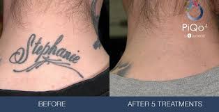 But a tattoo no longer has to be forever. Laser Tattoo Removal Forever Medspa