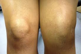Knee Effusion Or Swelling Of The Knee Colloquially Known As Water On The Knee Occurs When Excess Synovial Fluid Acc Swollen Knee Bursitis Knee Knee Ligaments