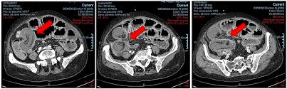 Image result for Adult Intussusception