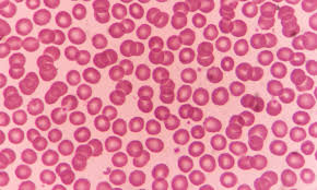 Image result for Anemia angolensis