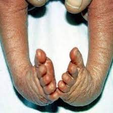 About half of children with clubfoot have it in both feet. Pbs Twimg Com Profile Images 2268257145 Talipes