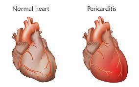 The cardinal symptom is chest pain that sometimes needs to be differentiated from the ischaemic pain. Pericarditis Types Symptoms Causes Treatment And Prevention