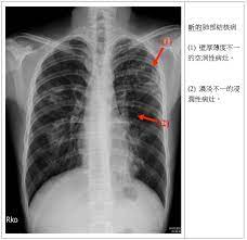 Check spelling or type a new query. è‚ºçµæ ¸ é†«å­¸å½±åƒå­¸ç¿'åœ'åœ°