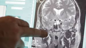 Hay que coger el listado e ir descartando, casi una por una, las demás posibilidades, sentencia la doctora. Diagnostico De La Em